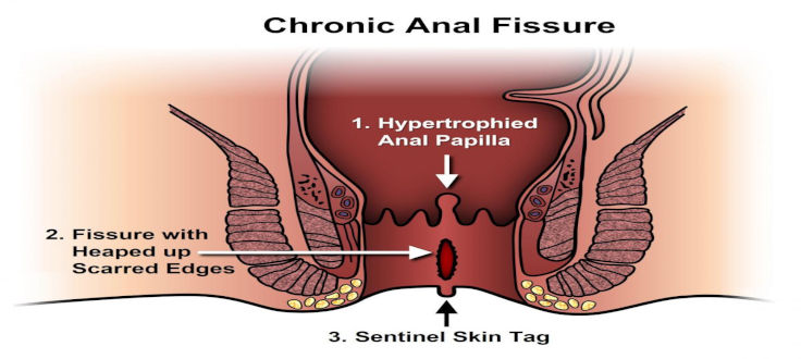 Anal Fissures